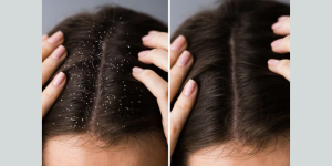 how to get rid of product build up in hair 